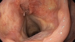 Плоскоклеточная неороговевающая карцинома гортани