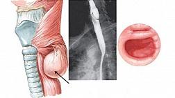 Классификация дивертикулов пищевода