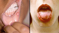 ПОРАЖЕНИЕ ЖЕЛУДОЧНО-КИШЕЧНОГО ТРАКТА ПРИ БОЛЕЗНИ БЕХЧЕТА