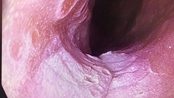 Поражение пищевода вирусной этиологии