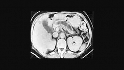 Хронический панкреатит