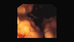 Лимфомa желудка