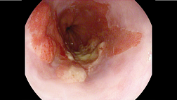 Клиническое наблюдение: Аденокарцинома Барретта