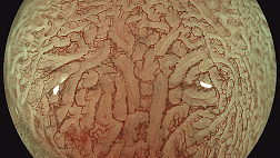 Пример оформления. ЭндоАтлас. Колоноскопия. Аденома. Bli