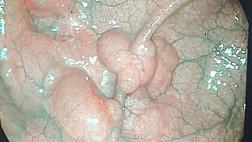 Пневматоз Толстой кишки