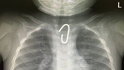 Эндоскописты Морозовской больницы удалили длительно фиксировнное (4месяца) инородное тело пищевода у ребенка!