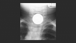 Инородные тела верхнего отдела ЖКТ