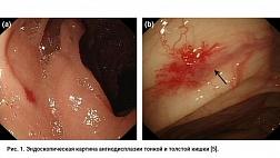 Ангиодисплазии желудочно-кишечного тракта. Классификация ангиодисплазий по Кузьмину А.М 1993 (ГНЦК). Классификация по Moore,  Lewi, Fowler 