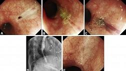 PGA ПРИ ПИЩЕВОДНО-ПЛЕВРАЛЬНОМ СВИЩЕ