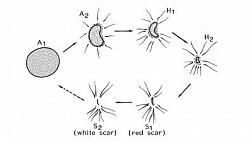 Фазы\стадии заживления язвы желудка по Sakita и Fukutomi
