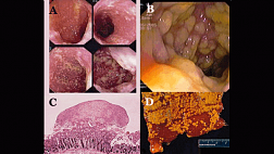 Псевдомембранозный колит: симптомы, лечение
