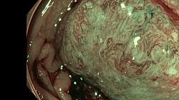 Инвазивная аденокарцинома сигмовидной кишки.