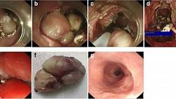 ЛЕЙОМИОМА ПИЩЕВОДА