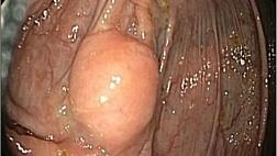 ШВАННОМЫ ЖЕЛУДОЧНО-КИШЕЧНОГО ТРАКТА