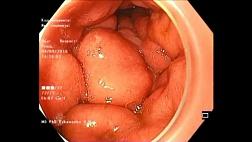 Linitіs plastica. Пластический линит. Видео