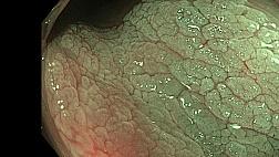 Sessile Serrated Lesion (SSL) - осмотр в NBI + хромоскопия уксусной кислотой