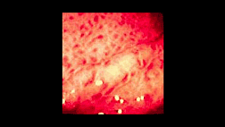 Гастропатия при портальной гипертензии. Классификация тяжести портальной гипертензивной гастропатии по McCormack T.T.