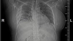 Применение эндоскопической клапанной бронхоблокации у пациентки 34 лет. Закон парных случаев в дейст