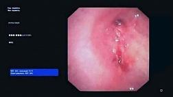 Успешно апробировано окклюзия бронхоплеврального свища