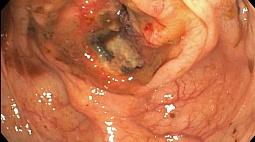 Стенозирующая инфильтративно - язвенная опухоль илеоцекального угла