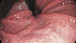 Портальная гипертензионная гастропатия