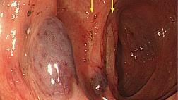 ЭНДОСКОПИЧЕСКАЯ СЕМИОТИКА ГАСТРОИНТЕСТИНАЛЬНОГО АМИЛОИДОЗА