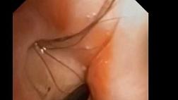 Клинический случай: Парикмахерское искусство в эндоскопии.