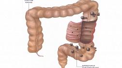 ДИВЕРТИКУЛЫ ТОЛСТОЙ КИШКИ НЕ СВЯЗАНЫ С ВОСПАЛЕНИЕМ СЛИЗИСТОЙ ОБОЛОЧКИ ИЛИ ХРОНИЧЕСКИМИ ЖЕЛУДОЧНО-КИШЕЧНЫМИ СИМПТОМАМИ