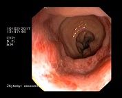 Эндоскопическая картина после ректального введения 2 мл раствора перекиси водорода H2О2