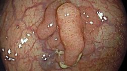 Аденокарцинома в аденоме