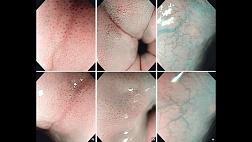 Узкоспекртральная эндоскопия NBI признаки при эозинофильном и лимфоцитарном эзофагите