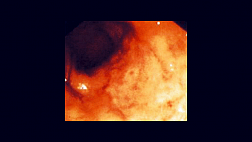 Синдром солитарной язвы прямой кишки