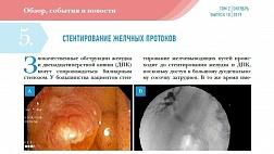 СТЕНТИРОВАНИЕ ЖЕЛЧНЫХ ПРОТОКОВ