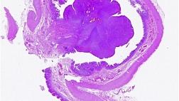 ВОСПАЛИТЕЛЬНАЯ МИОФИБРОБЛАСТИЧЕСКАЯ ОПУХОЛЬ