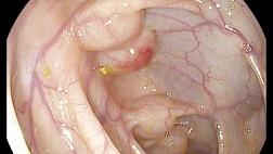 Кистозный пневматоз толстой кишки.