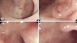 МЕТАХРОННЫЙ РАК