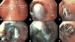 Дивертикулотомия Ценкера с сохранением слизистой оболочки