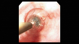 Баллонная дилатация стриктур ЖКТ