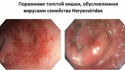 Поражение толстой кишки, обусловленное вирусами семейства Herpesviridae.