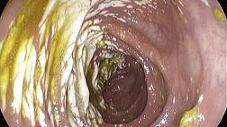 Colonic pseudolipomatosis Псевдолипоматоз толстой кишки
