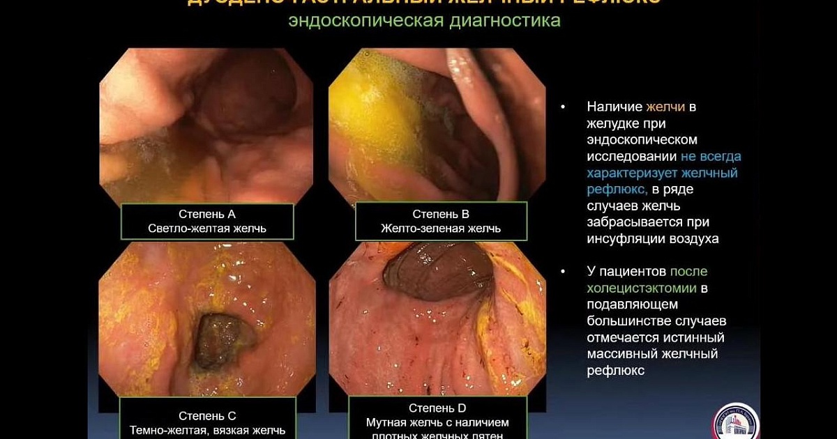 Заброс желчи: почему происходит, симптомы, что делать, как лечить?