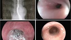 СТЕРОИДЫ ПРИ РУБЦОВОМ СУЖЕНИИ ПИЩЕВОДА