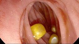 ЖКБ: холедохолитиаз