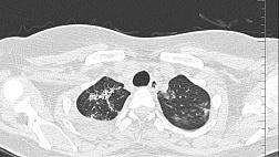 Повторная блокация промежуточного бронха