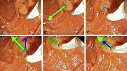 Статья и обучающее видео: методика канюляции БДС при ЭРХПГ 2020.