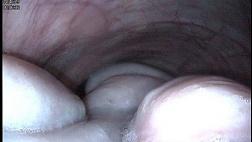 Фиброваскулярный полип пищевода. 