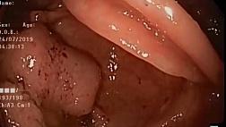 Состояние после операции Гарлока. Эзофагогастроанастомоз. Бужирование стеноза анастомоза.