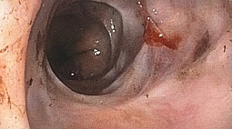 ВРВП на фоне рубцовых изменений слизистой пищевода.