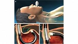 Эндоскопический ультразвуковой степлер Muse (Medigus Ultrasonic Surgical Endostapler MUSE)