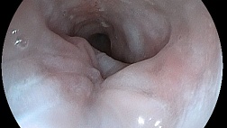 Пищеводно-плевральный свищ на фоне ахалазии кардии